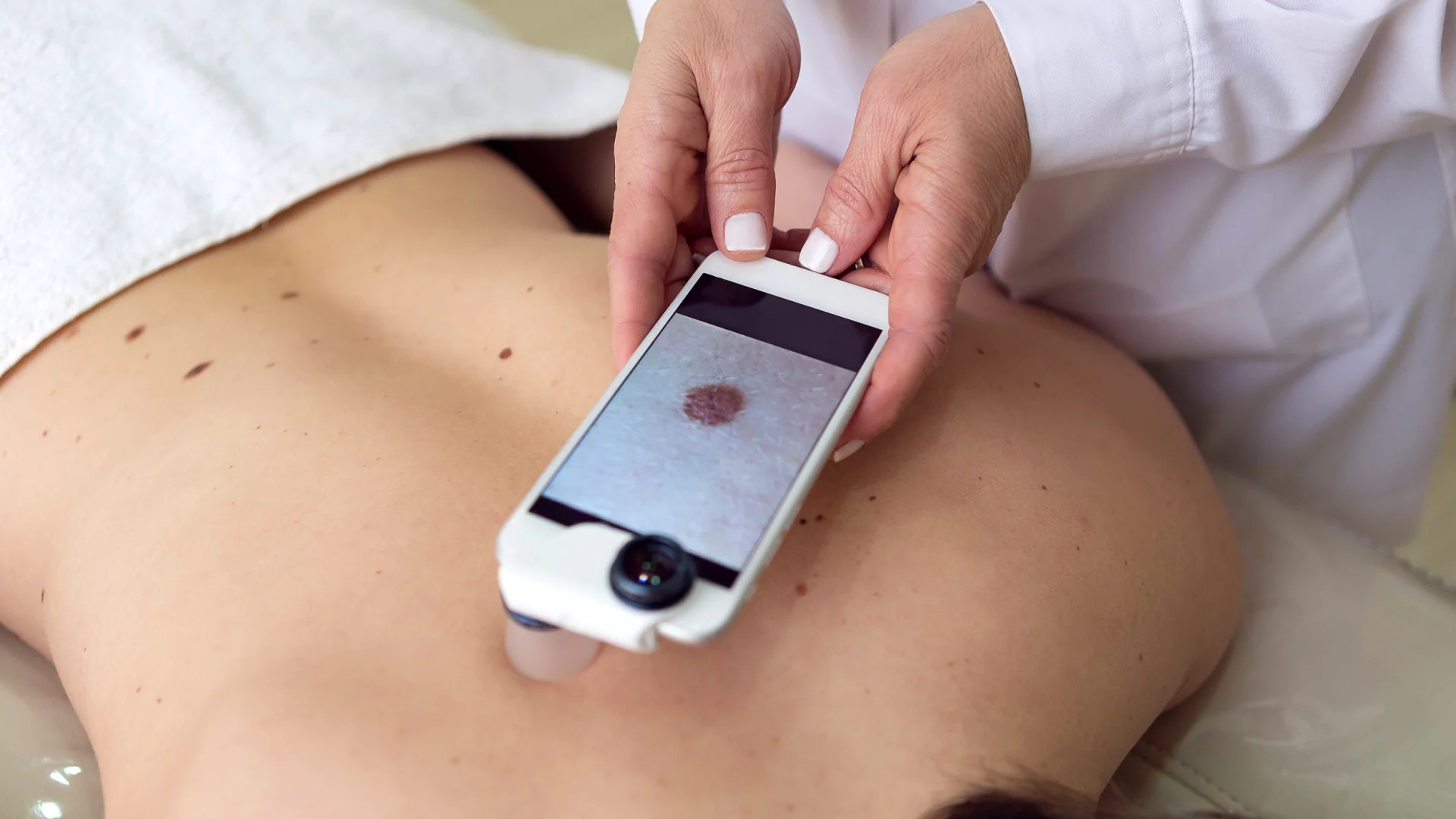 Fotografie zeigt Nahaufnahme einer Hautuntersuchung mit Smartphone, das ein vergrößertes Muttermal auf dem Rücken einer Person darstellt. Fokus liegt auf medizinischer Hautanalyse zur Erkennung möglicher Hautveränderungen oder Erkrankungen.